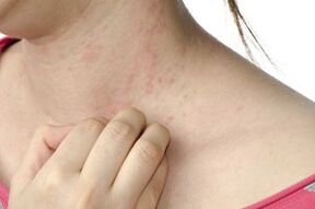 Skin rashes from parasites